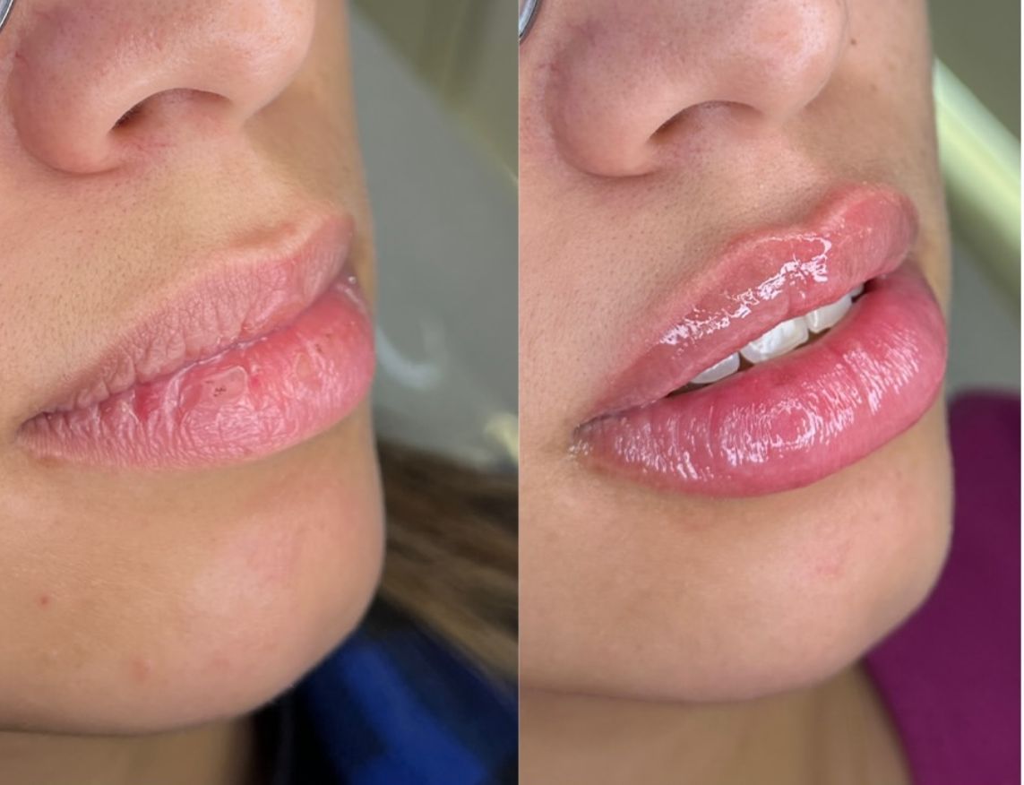 Preenchimento labial resultado